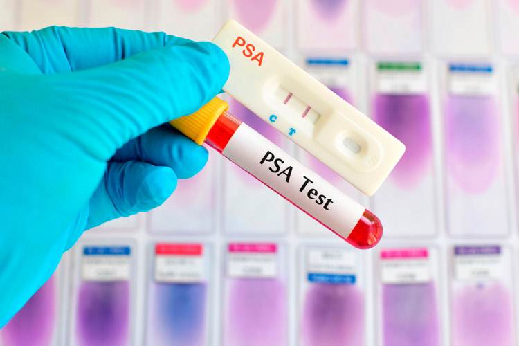 Médico especialista analiza una muestra de sangre para la prueba de antígeno prostático específico en un laboratorio