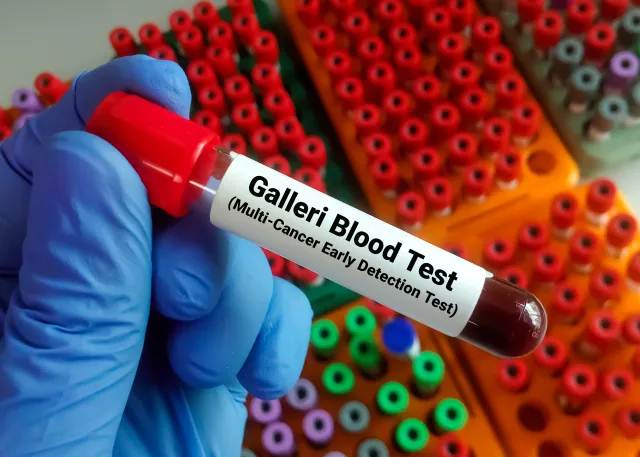 El test Galleri representa uno de los mayores avances en oncología médica al reducir hasta un 26 % el diagnóstico de cáncer avanzado